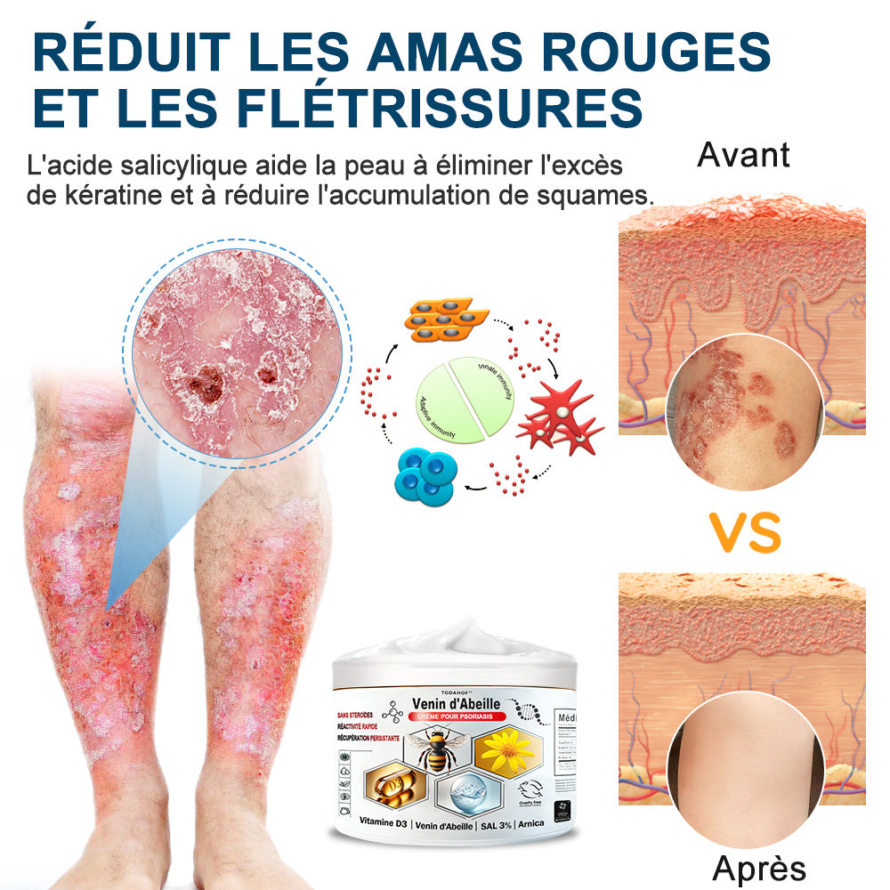 🌱TODAHOF™ Psoriasis Crème Venin d'Abeille (👨‍⚕️Recommandé par SFD)