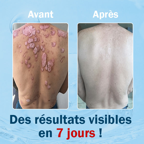 🌱TODAHOF™ Psoriasis Crème Venin d'Abeille (👨‍⚕️Recommandé par SFD)