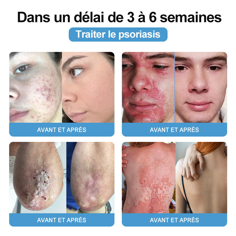 🌱TODAHOF™ Psoriasis Crème Venin d'Abeille (👨‍⚕️Recommandé par SFD)