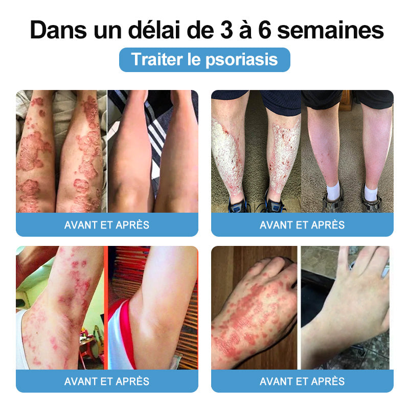 🌱TODAHOF™ Psoriasis Crème Venin d'Abeille (👨‍⚕️Recommandé par SFD)