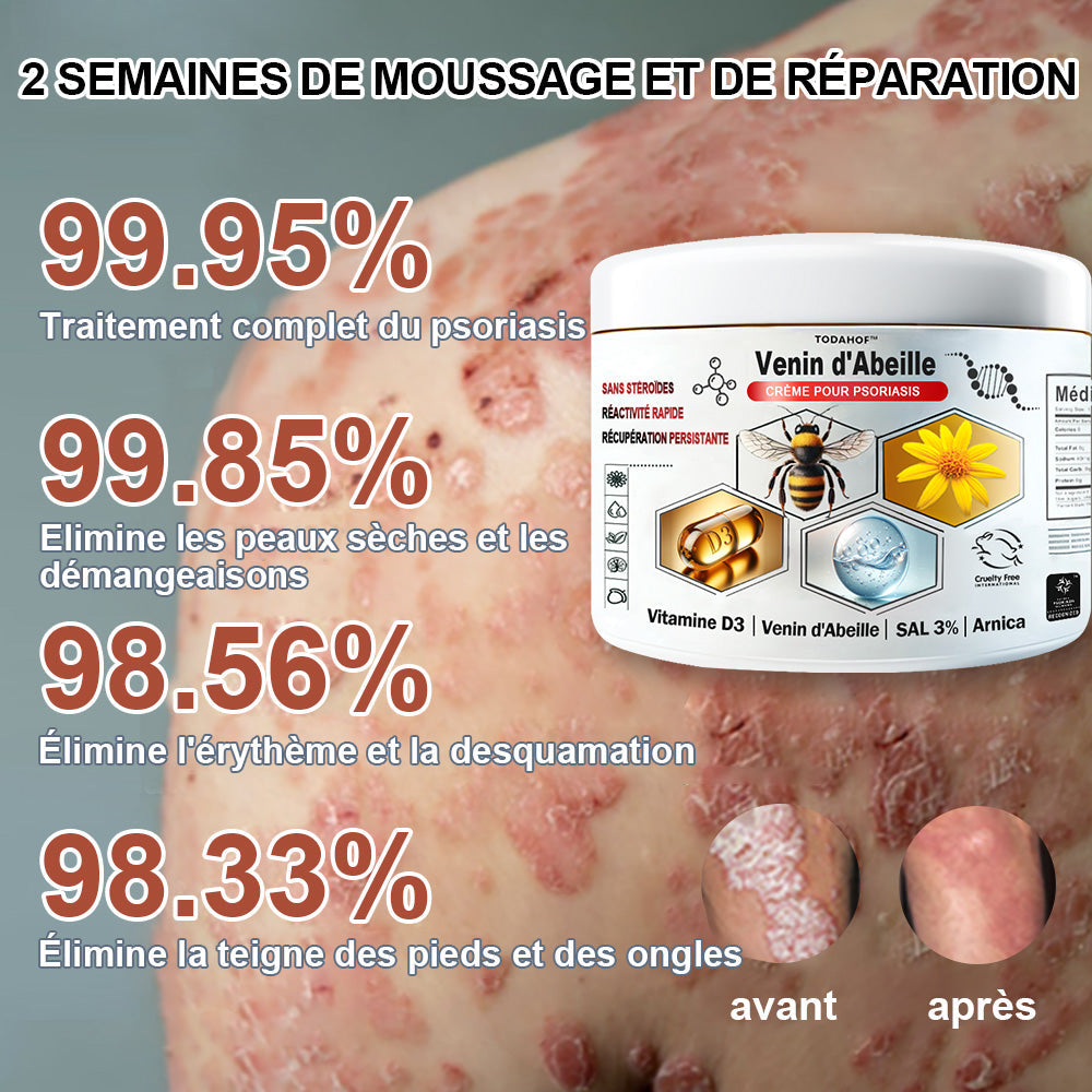 🌱TODAHOF™ Psoriasis Crème Venin d'Abeille (👨‍⚕️Recommandé par SFD)